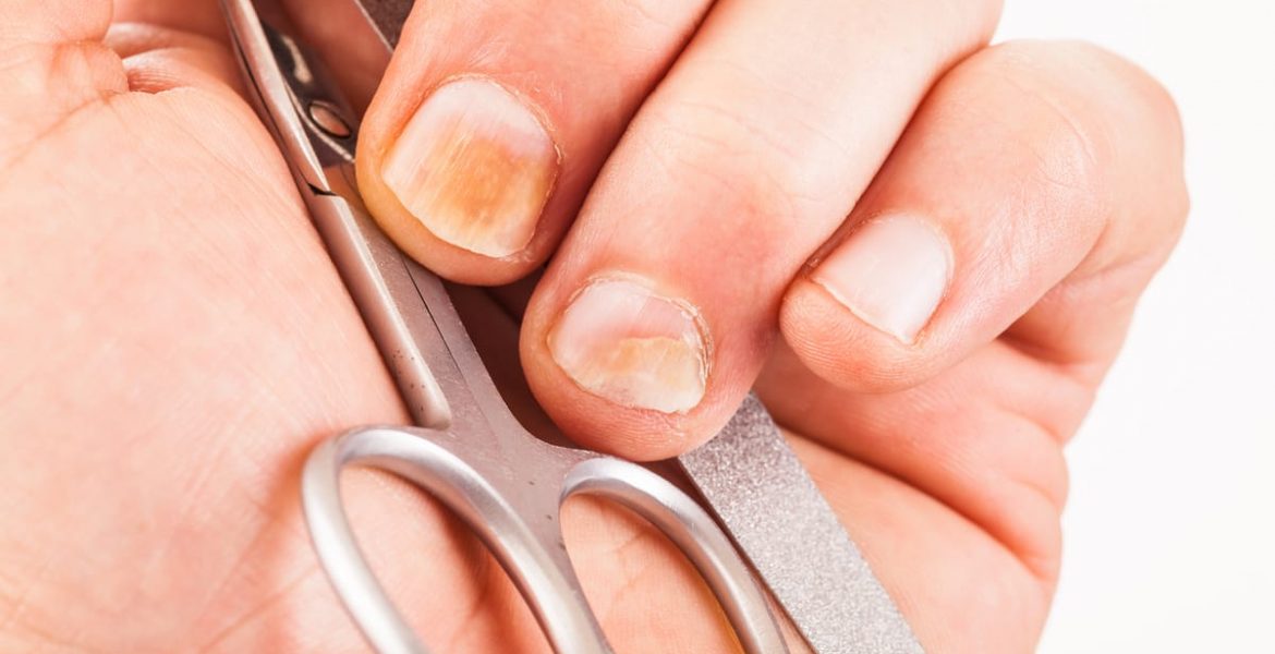 medicamentos para hongos uñas manos